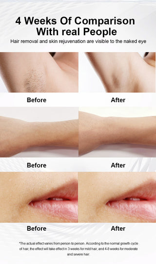 Numiere IPL Hair Removal with Ice Cooling