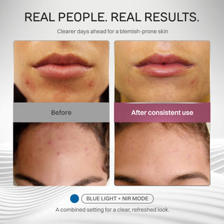 Time Keeper Wrinkle Reducing LED Face Mask